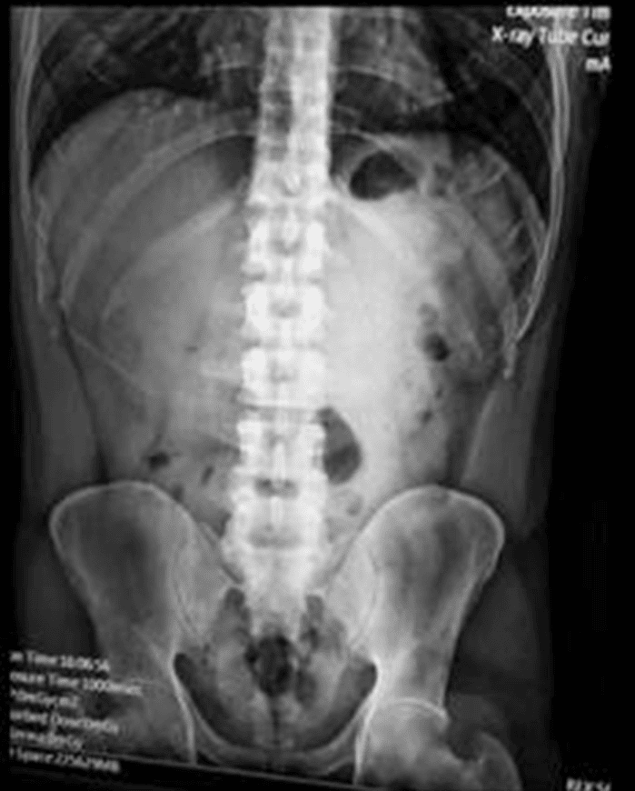 Intususcepción ileo-cecal Radiografía simple del abdomen